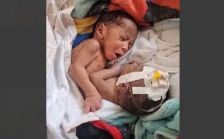 Tupla Conjoined Twins from Finschafen in Good Health