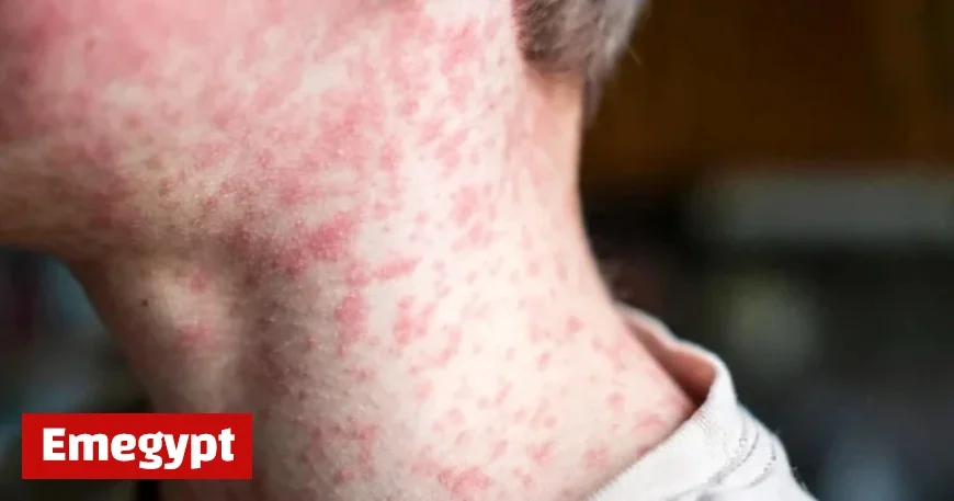 Minnesota’s Measles Cases Surge to 20 as Unvaccinated Children Face Greater Risk