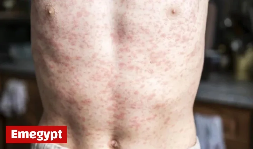 South Carolina Measles Outbreak Escalates, Threatens Canada’s Elimination Status