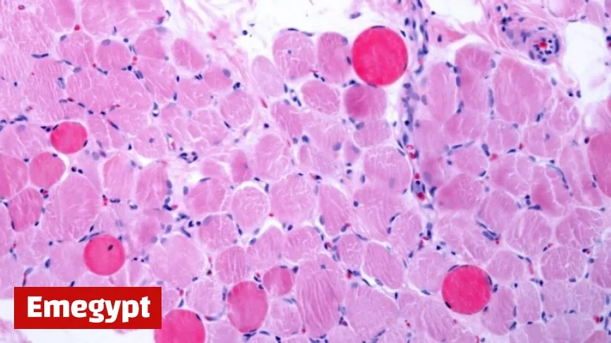 Capricor’s Cell Therapy Boosts Heart and Muscle Function in Duchenne Patients